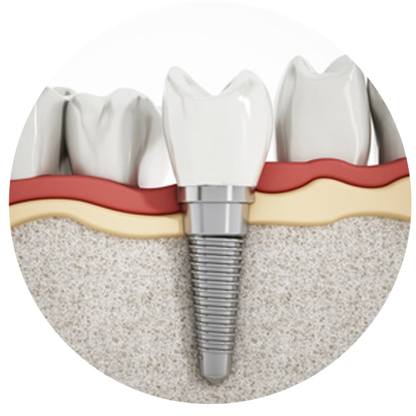 Dental-Implants-kits Home